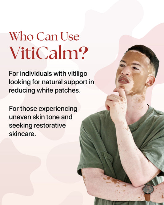 VitiCalm : Cream for Vitiligo | Vitiligo Treatment Solution