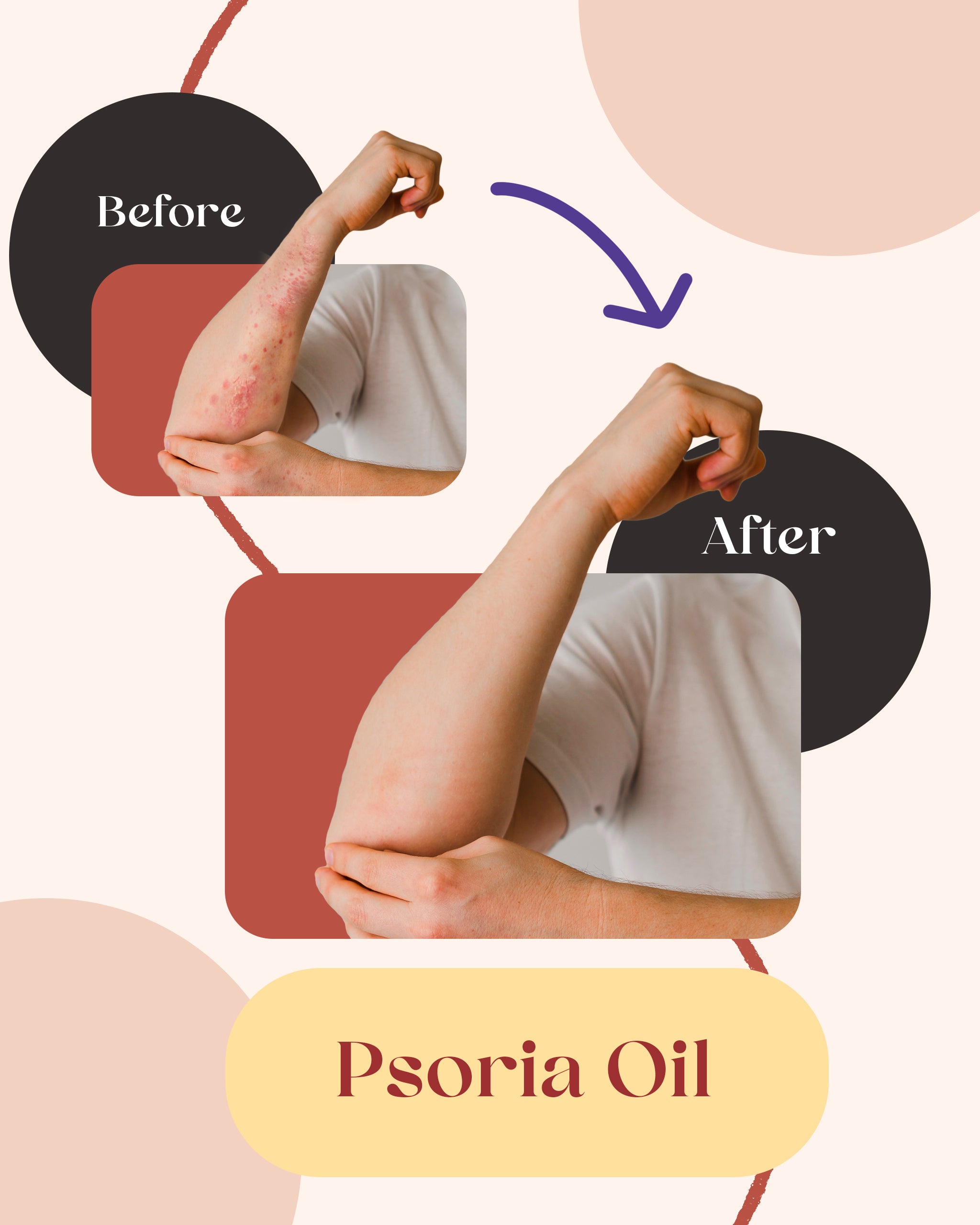 Psoria Oil